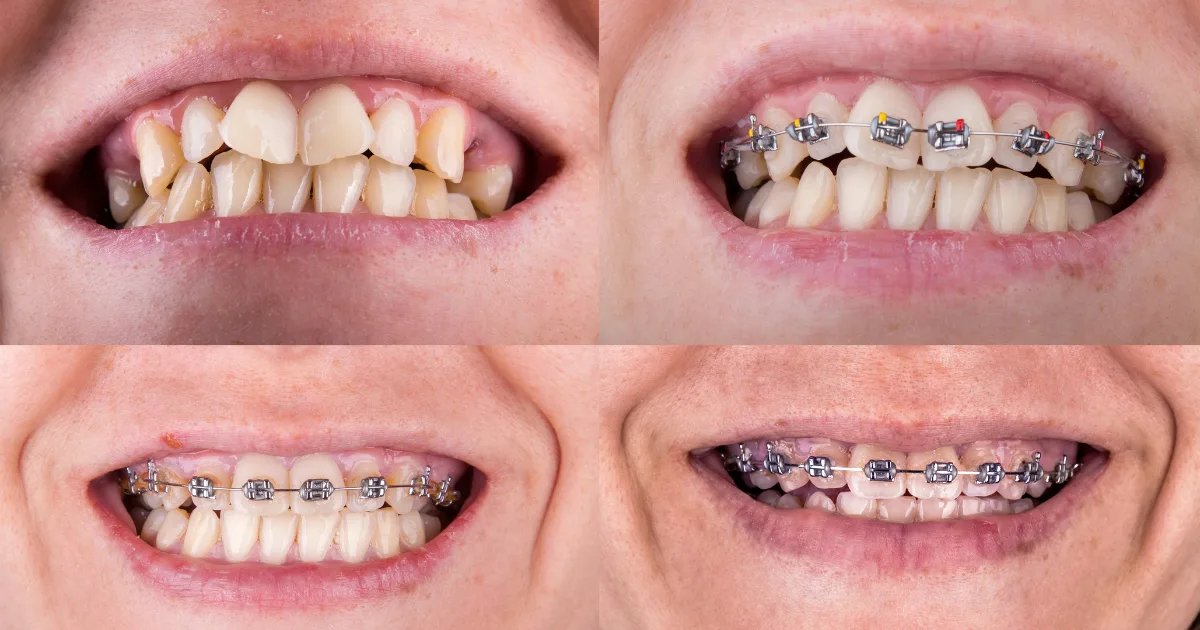 Denver co braces a trusted choice for families