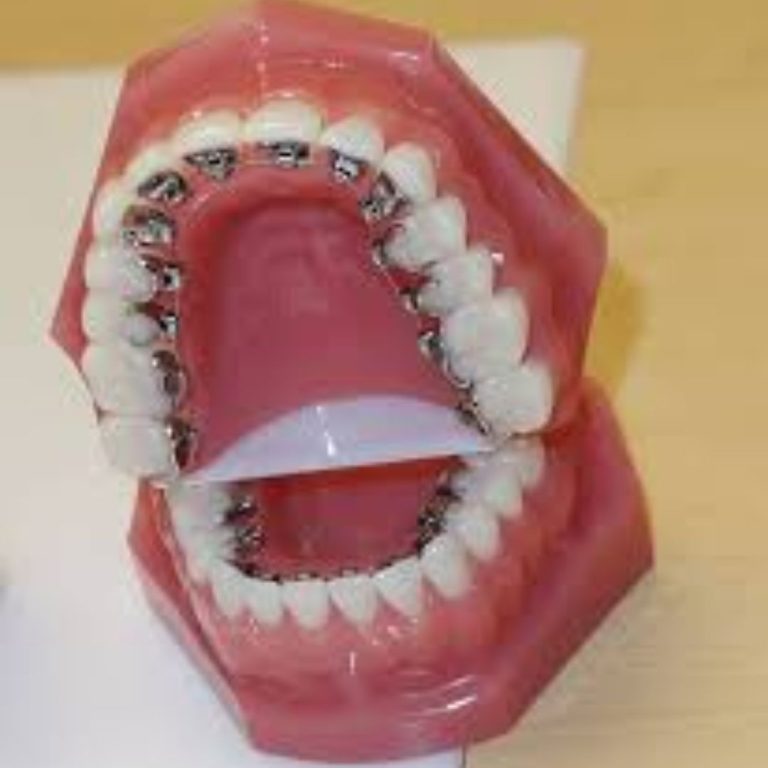 Lingual braces