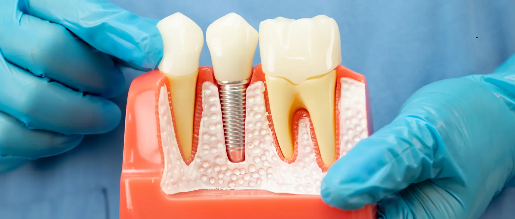 Affordable dental implants