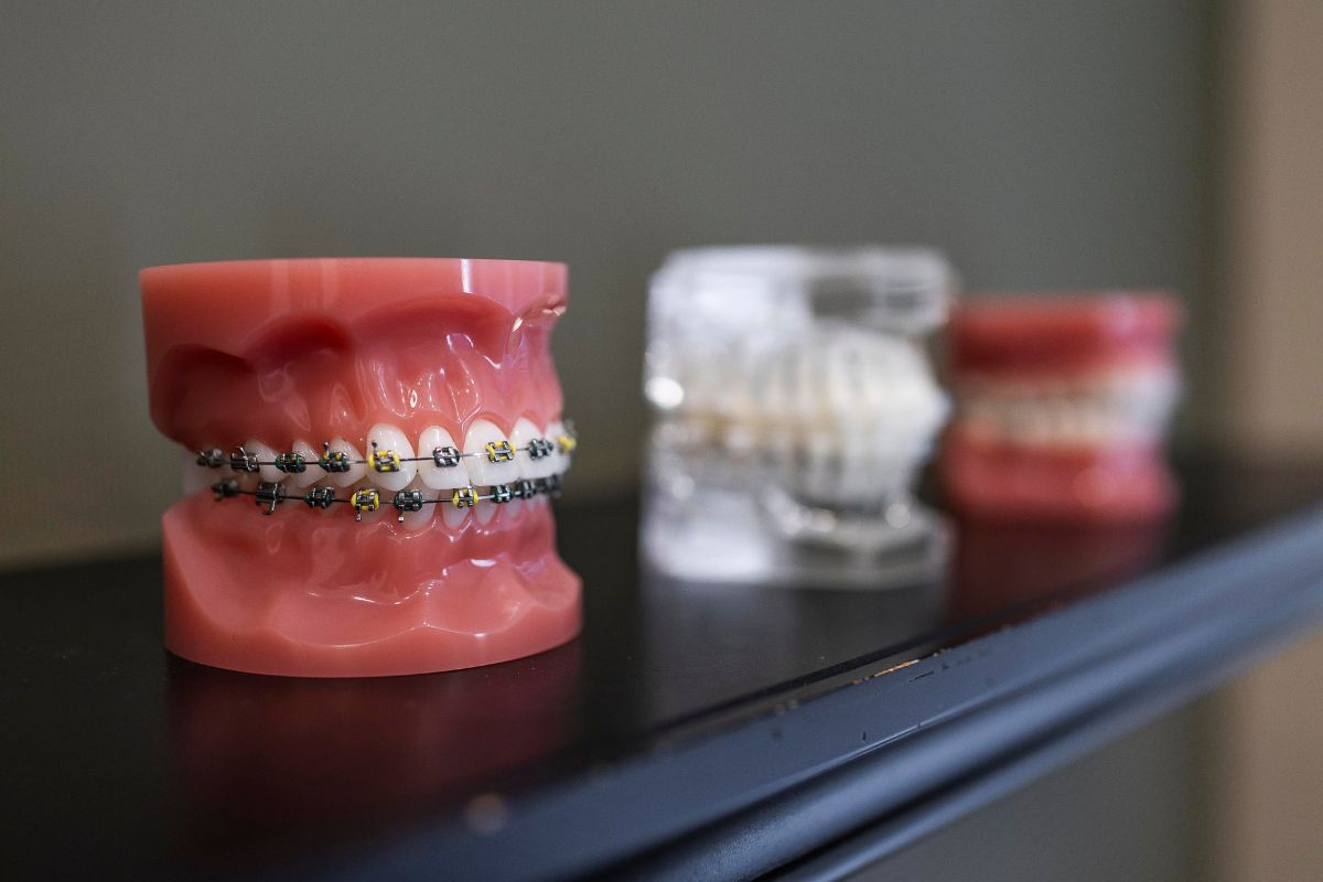 Clear and metal braces models at Kohrs Orthodontics in Aurora, Bennett, Strasburg, Colorado showing orthodontic treatment options